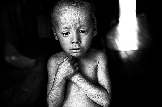 Lucas Techeira wurde mit einer unheilbaren Hautkrankheit geboren, verursacht durch einen Gendefekt, Argentinien, 2014© Pablo E. Piovano